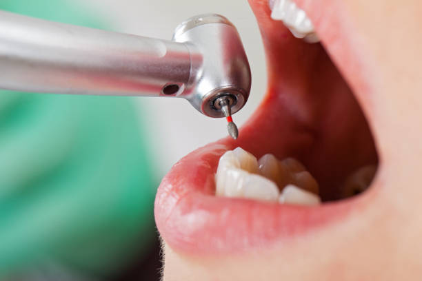 Best Root Canal Emergency Dentist  in Kettering, MD